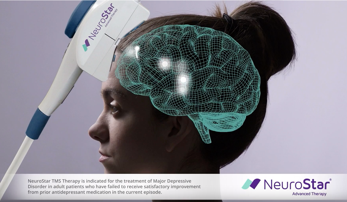 NeuroStar TMS